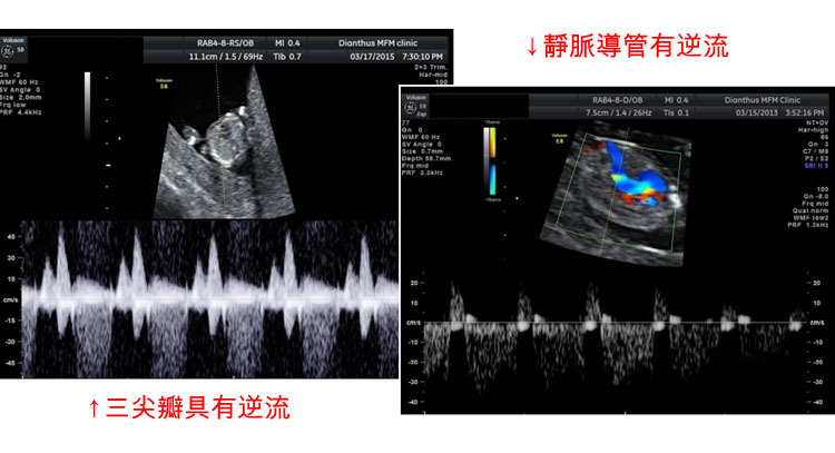 初期唐氏症超音波 媽咪愛 育兒問答