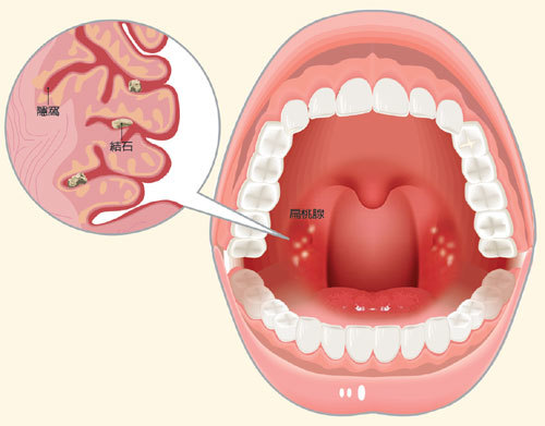 我的經驗 餐餐咳竟是扁桃腺結石 耳鼻喉 健康百科 元氣網