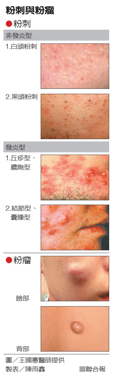 熱敷讓粉瘤和粉刺自爆 皮膚 健康百科 元氣網