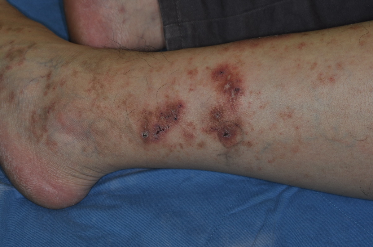 腳潰爛留白疤竟是血管阻塞造成 皮膚 健康百科 元氣網