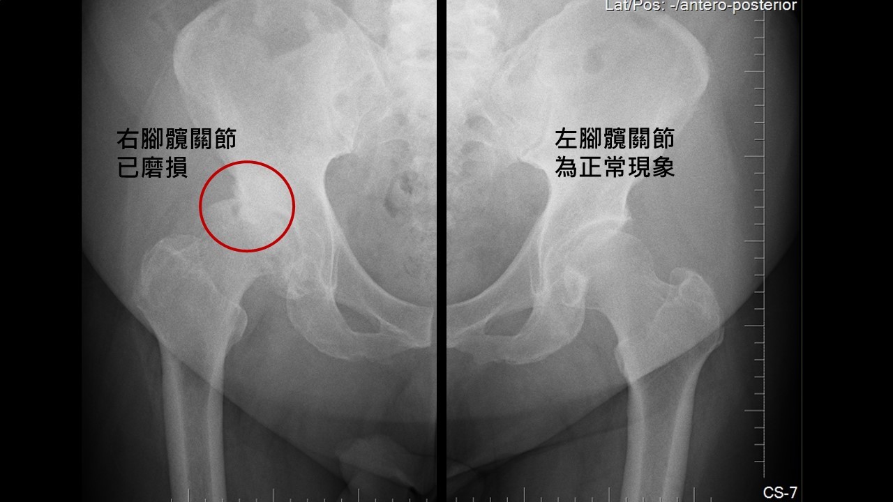 百公斤男做髋關節置換醫師建議 用機器手臂 骨科 復健 科別 元氣網