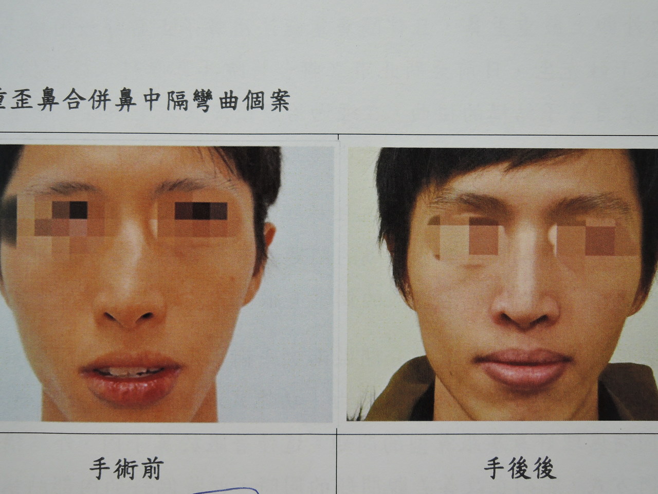 動歪鼻矯正手術解決鼻塞連鼻型都變美 耳鼻喉 科別 元氣網