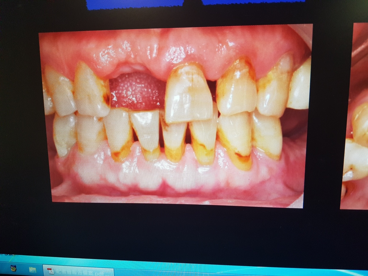 牙齒拔掉就ok了嗎 牙醫師建議先進行齒槽脊保存術 牙科 科別 元氣網