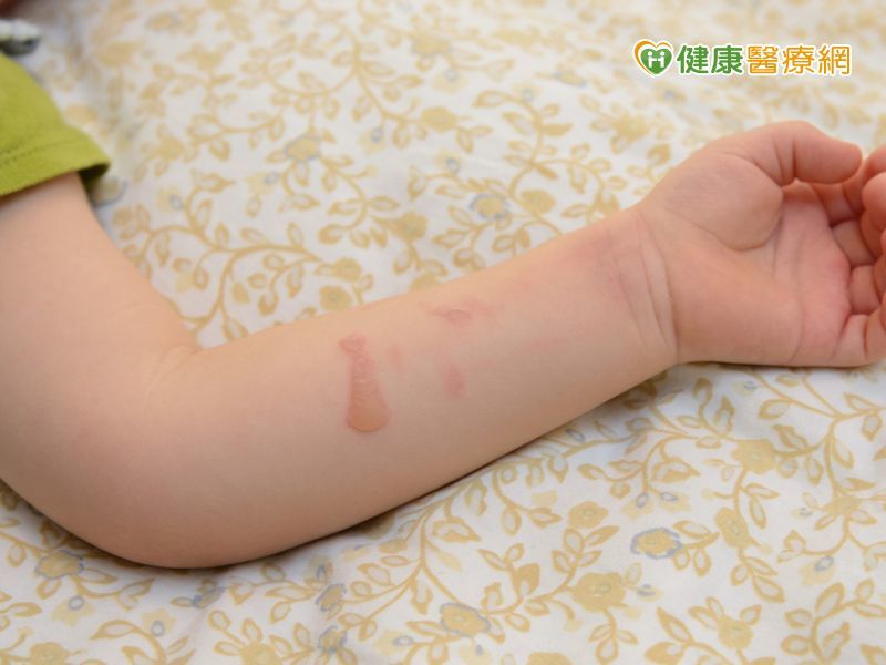 燒燙傷怎麼辦 緊急處置sop這樣做 一般外科 科別 元氣網