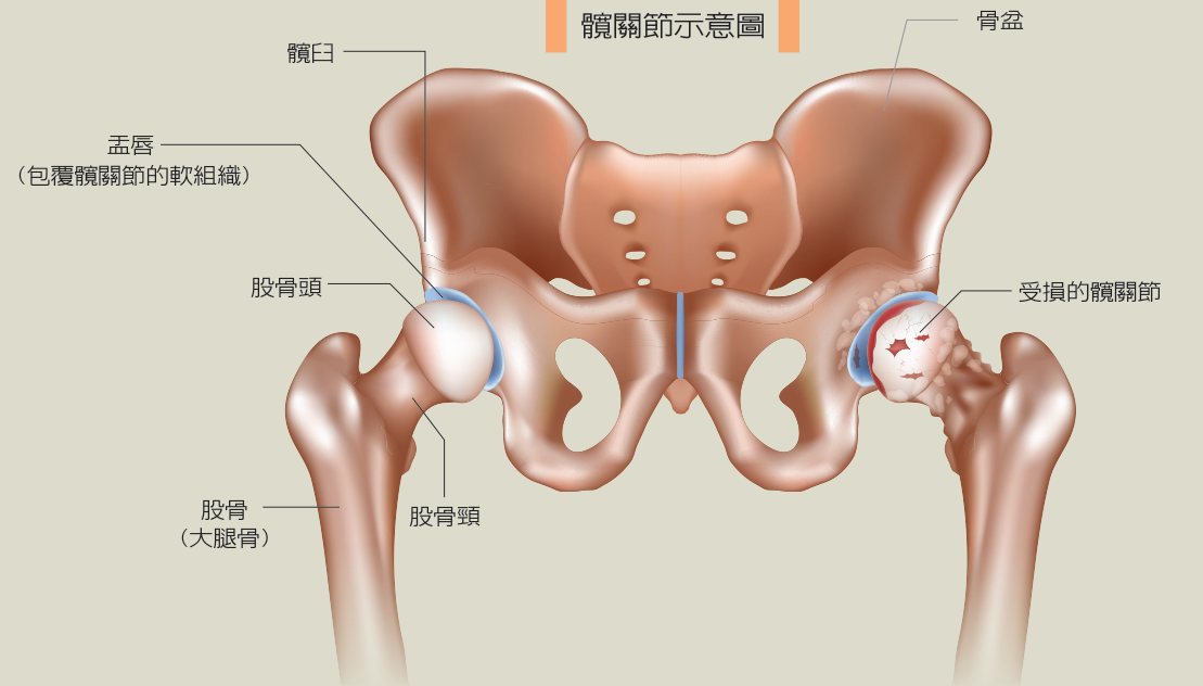 把皮包塞屁股口袋也算 骨科醫說這些動作最傷髖關節 骨科 復健 科別 元氣網