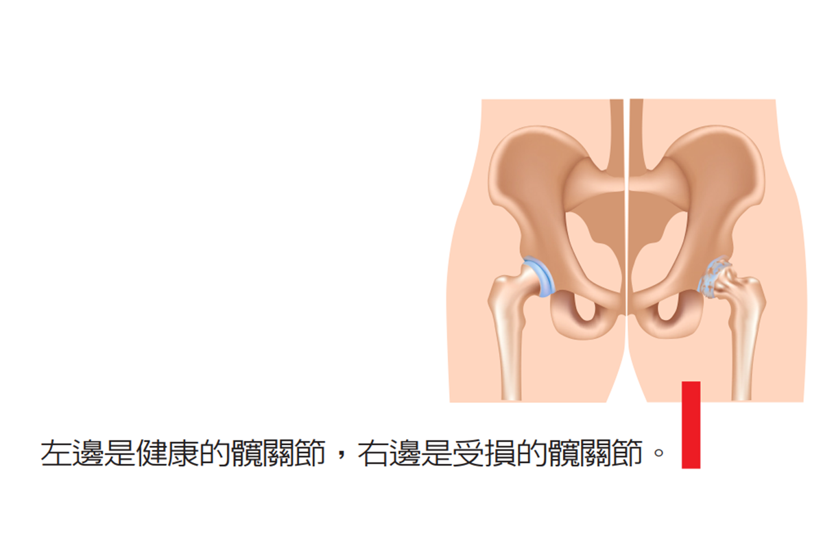 老爸年事已高換髖關節安全嗎 3點評估是否適合手術 骨科 復健 科別 元氣網