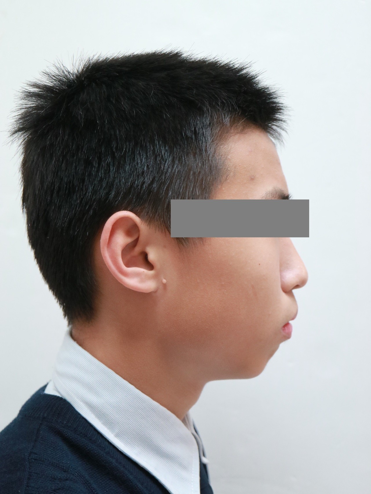 小孩沒下巴 醫師警告 下顎短者易暴牙 心血管疾病 牙科 科別 元氣網