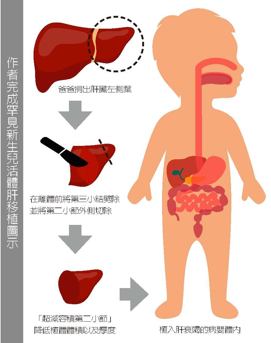 5種狀況兒童可做肝移植 器官捐贈移植 新聞 元氣網
