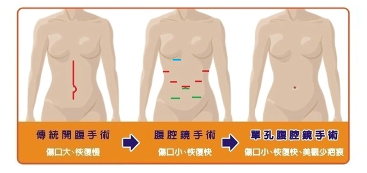 肚臍內作微創腹腔鏡手術術後幾近無疤 一般外科 科別 元氣網