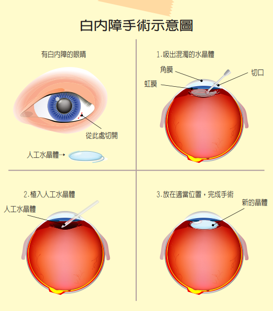 白內障手術該挑 健保片 好還是挑 自費片 好 眼部 科別 元氣網