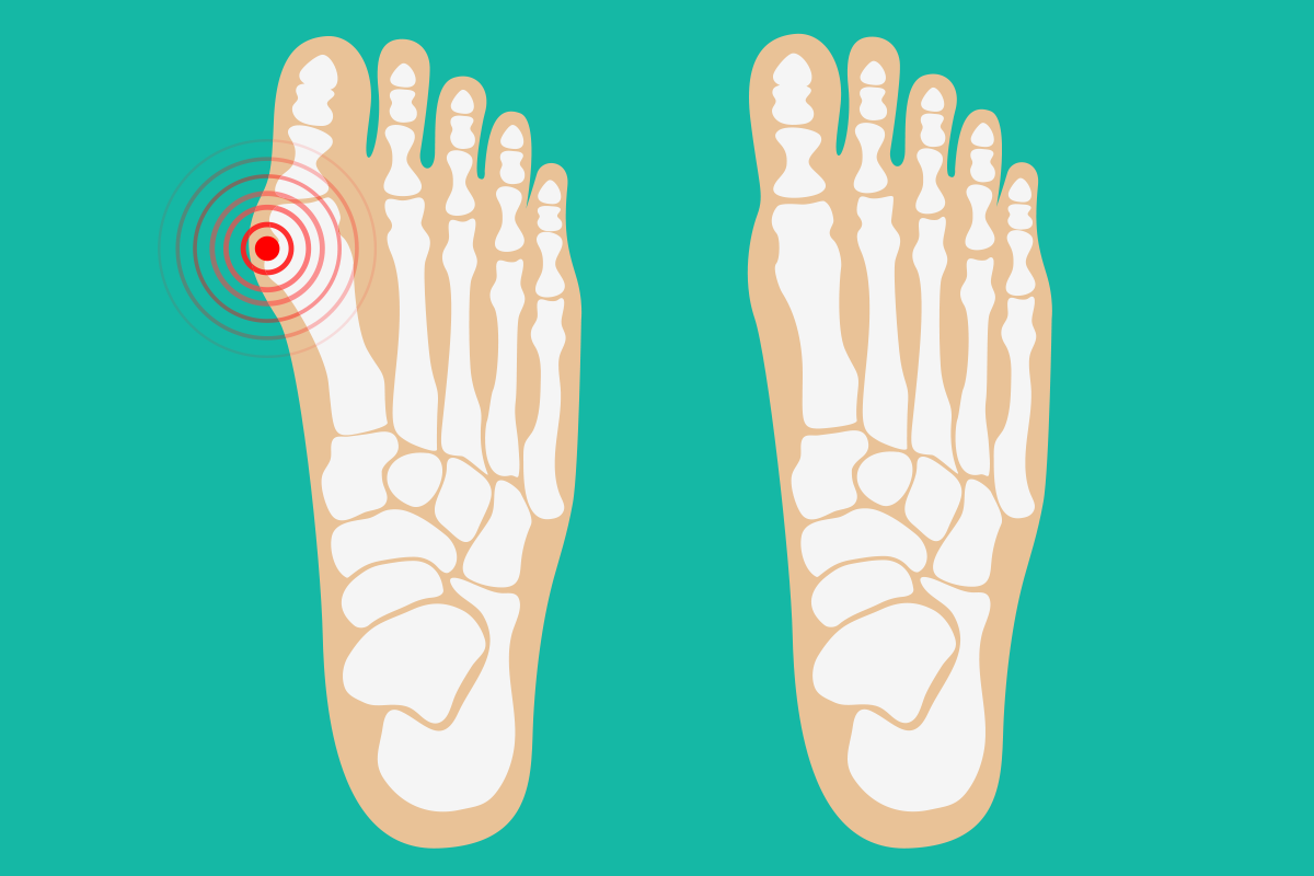 拇趾外翻走路就痛 骨科醫 最重要的原因不是穿錯鞋 骨科 復健 科別 元氣網