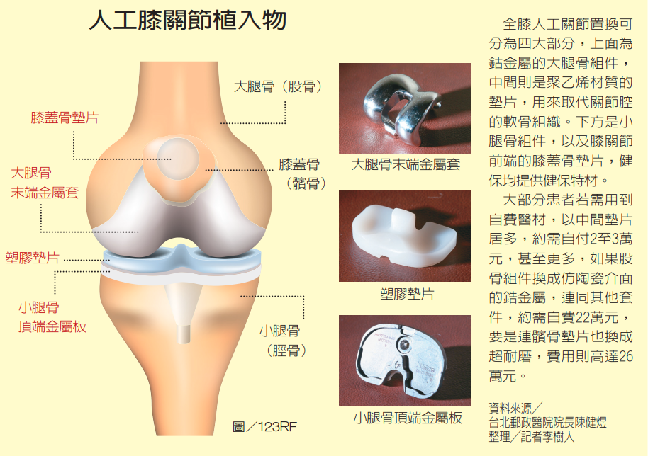 換膝關節必知 健保或自費關鍵在塑膠墊片 骨科 復健 科別 元氣網