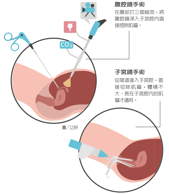 子宮肌瘤何時該考慮切除 婦科權威 體積超過5公分 婦科 科別 元氣網