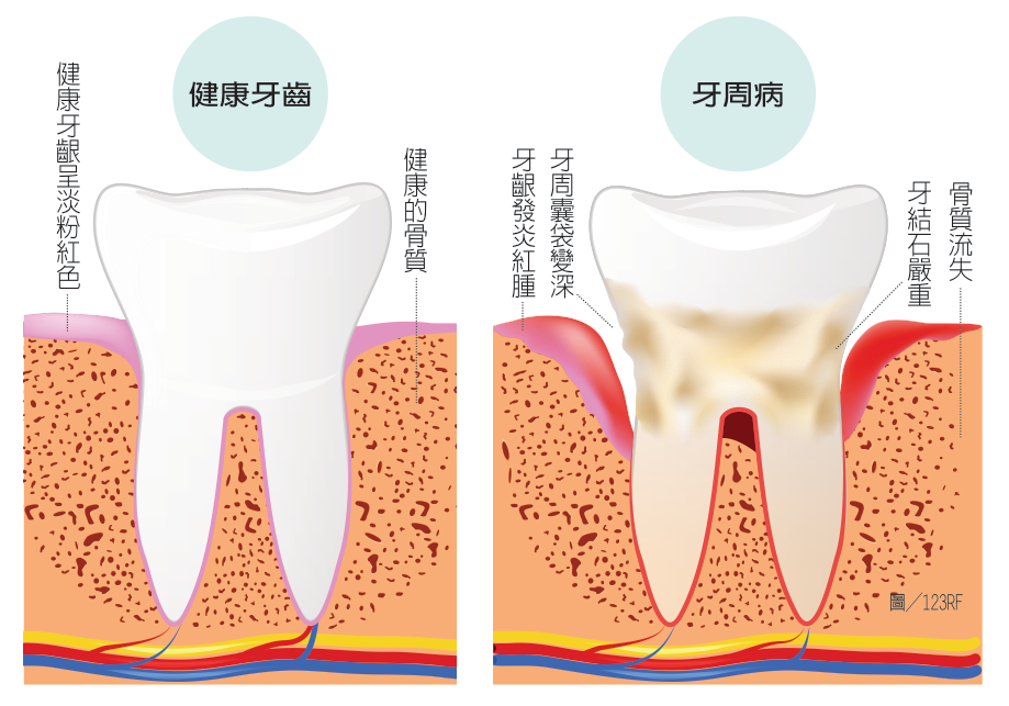 牙周病愈嚴重自費機率愈高這些項目都可能要多花錢 牙科 科別 元氣網