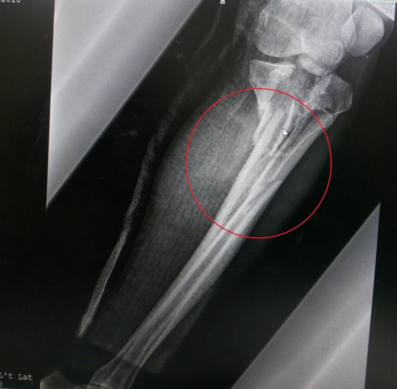 車禍造成左膝粉碎性骨折阻血流男子險截肢 骨科 復健 科別 元氣網