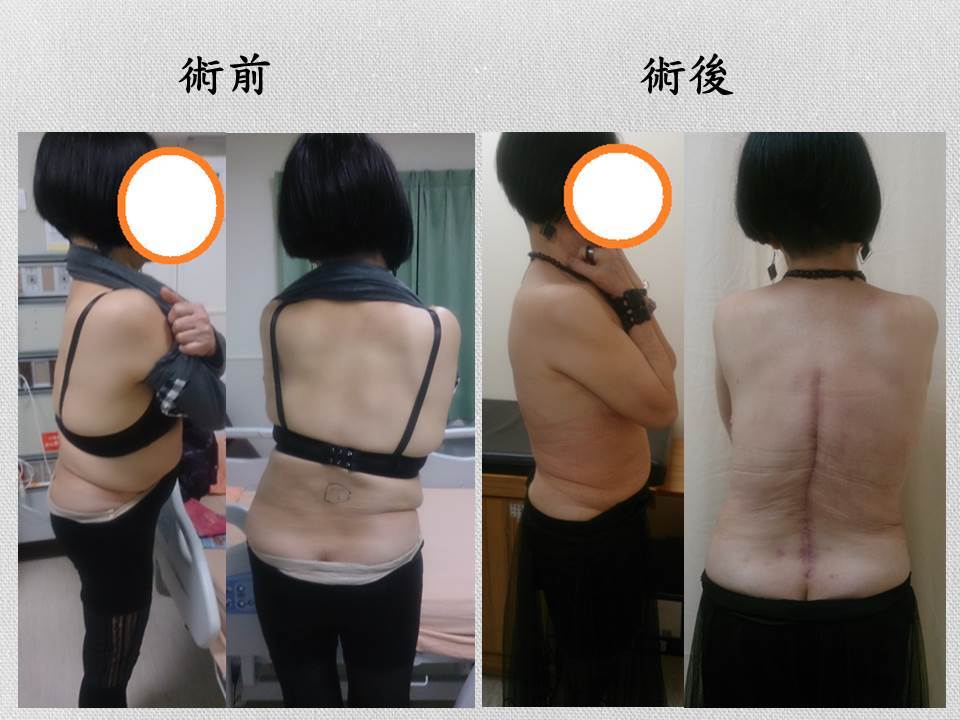 脊椎側彎手術 除了直 還得到了什麼 閻曉華脊骨神經醫學網