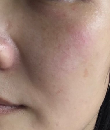 毛孔粗大趕快去角質 醫師破解去角質3大迷思 皮膚 科別 元氣網