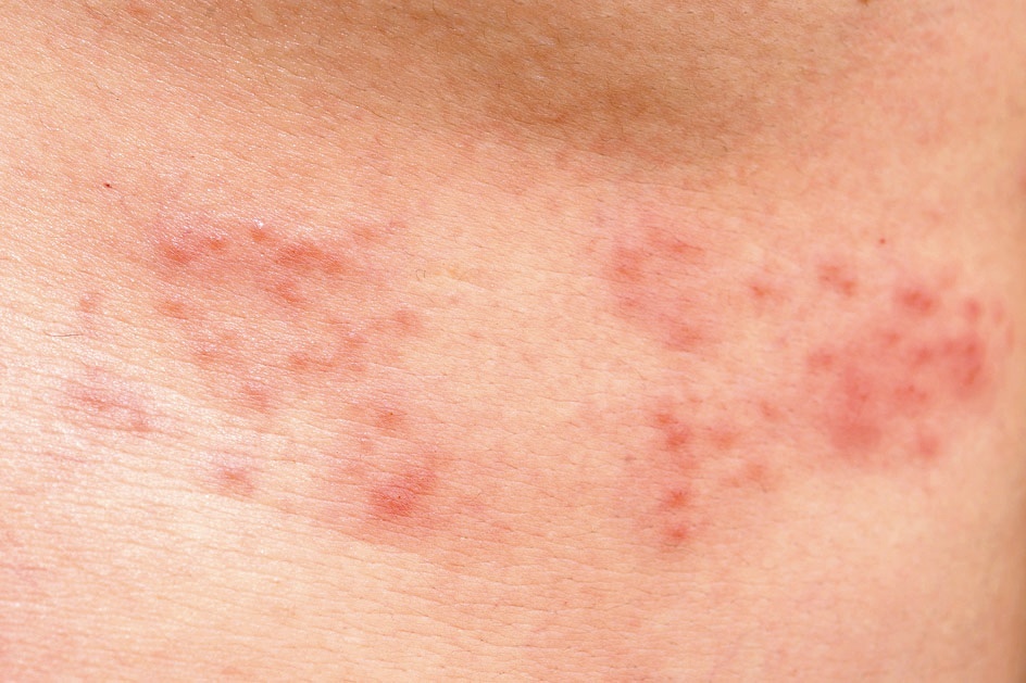 令人畏懼的帶狀疱疹何時容易發作 這項因素是關鍵 皮膚 科別 元氣網