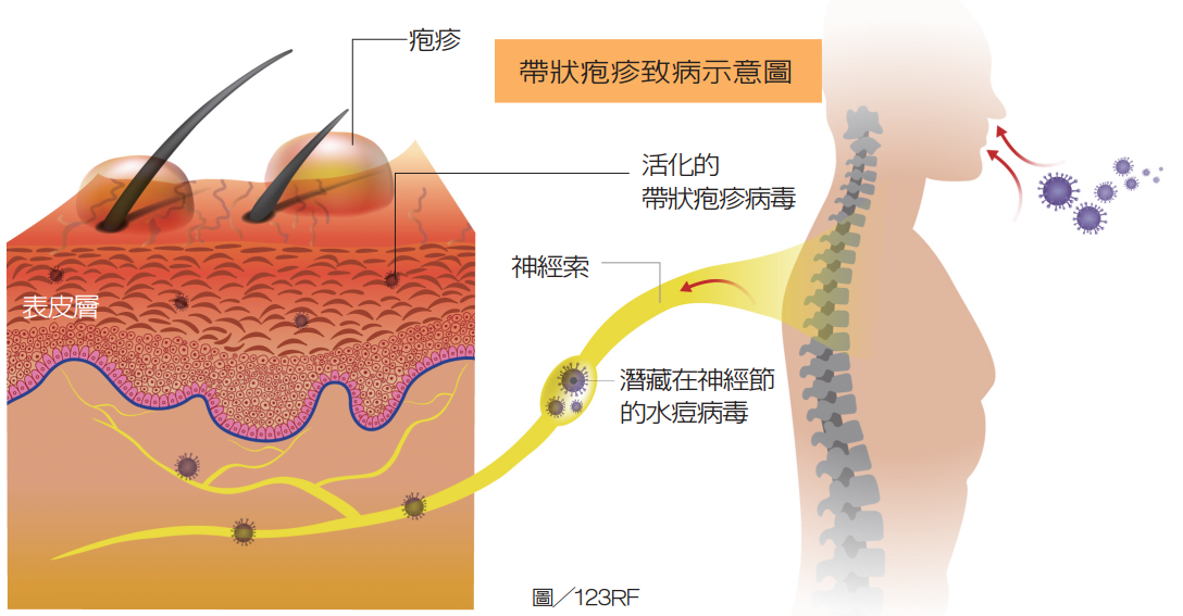 罹患帶狀疱疹該上大醫院嗎 皮膚科醫師教你判斷依據 皮膚 科別 元氣網