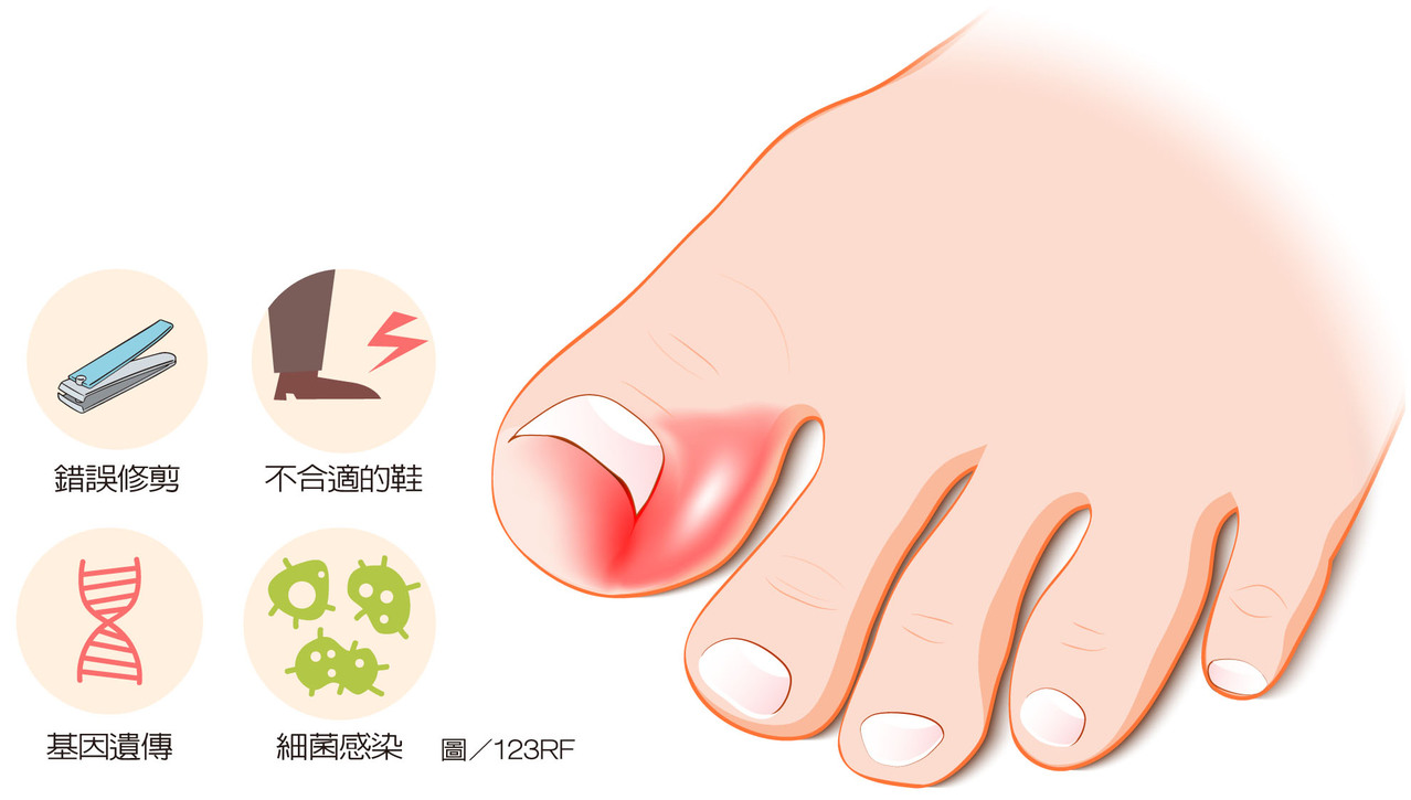 痛 指甲長進肉錯誤修剪 穿錯鞋引來甲溝炎 指甲 足部 科別 元氣網