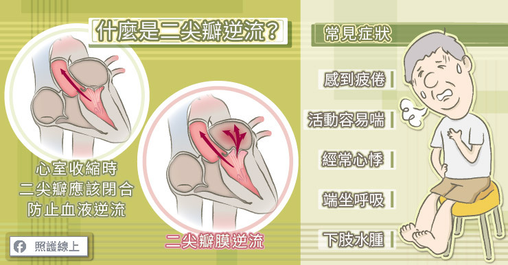 經常頭暈 胸悶 喘不過氣 醫師 當心二尖瓣逆流 盛行率比想像中高 心臟血管 科別 元氣網
