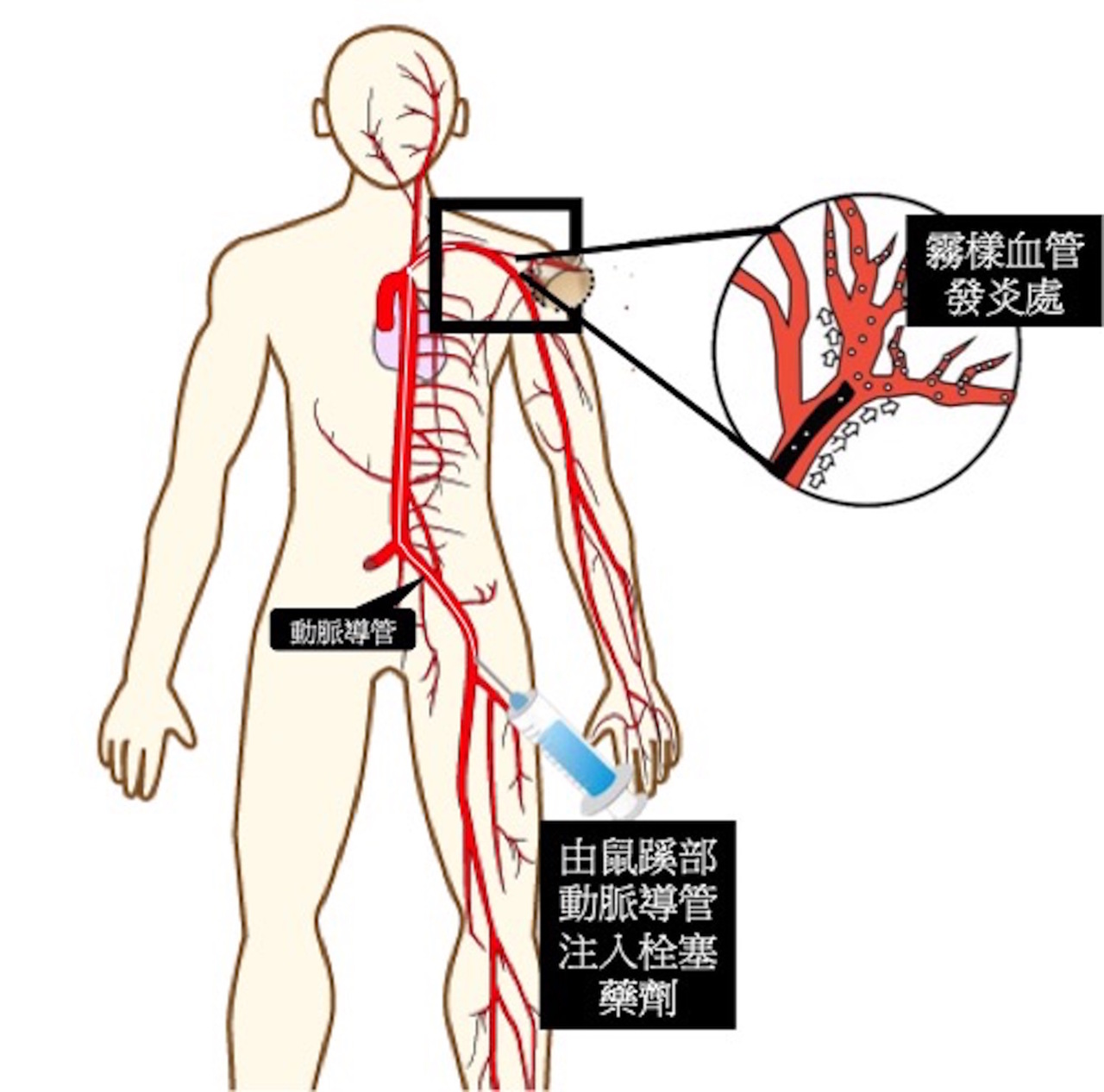 微创血管栓塞术缓解关节痛 医药百科 健康 世界新闻网 微创血管栓塞术缓解关节痛 医药百科 健康 世界新闻网