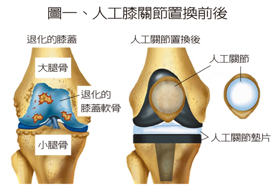 退化性關節炎 不是老人專利 換人工膝關節 不需荷包大失血 科普好健康 新聞 元氣網