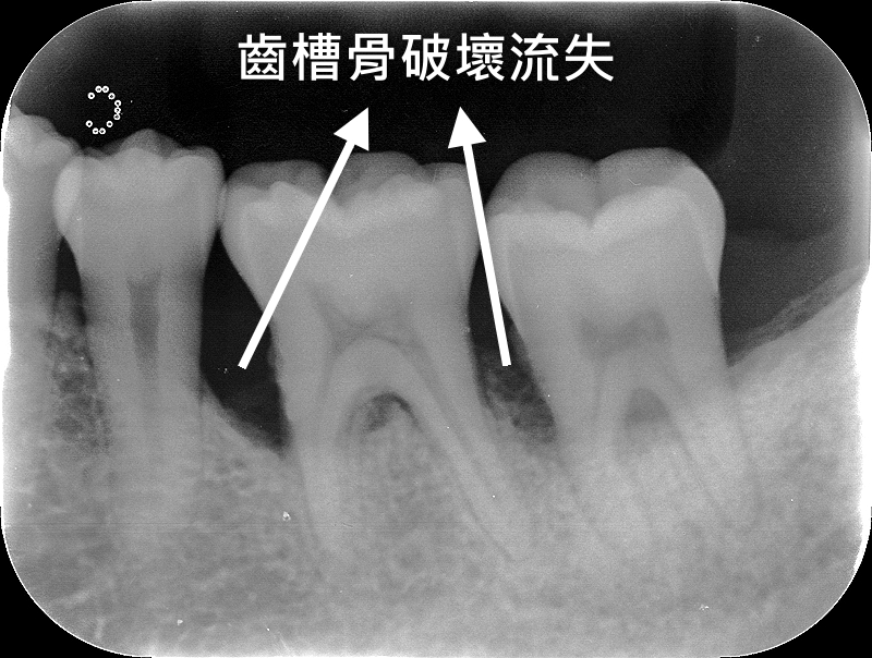 为什么会牙槽骨流失 帮你揪出了这3大真凶 牙齿