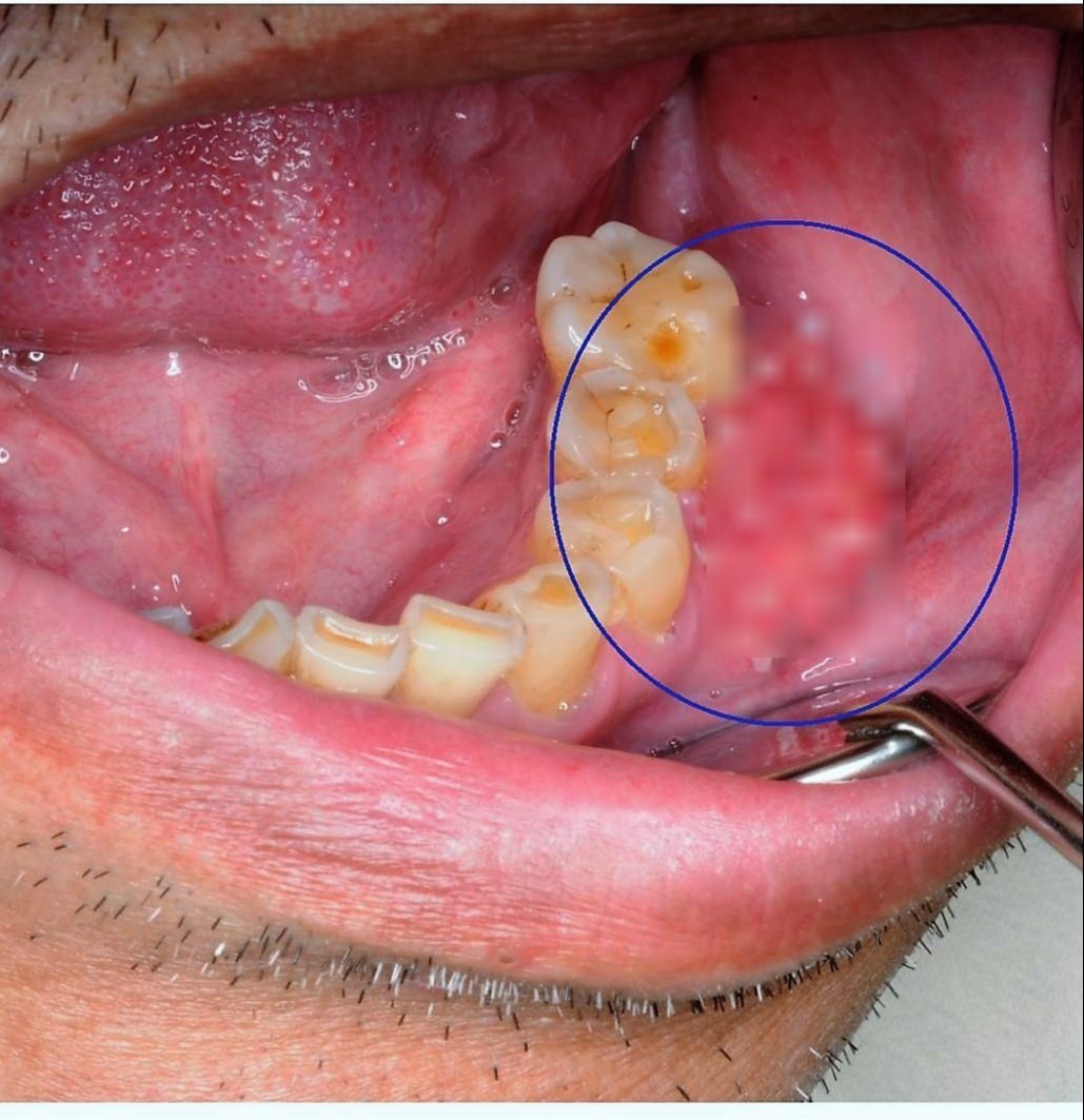 40歲壯男吸菸嚼檳榔得口腔癌手術取小腿骨與皮膚重建 頭頸癌 癌症 元氣網