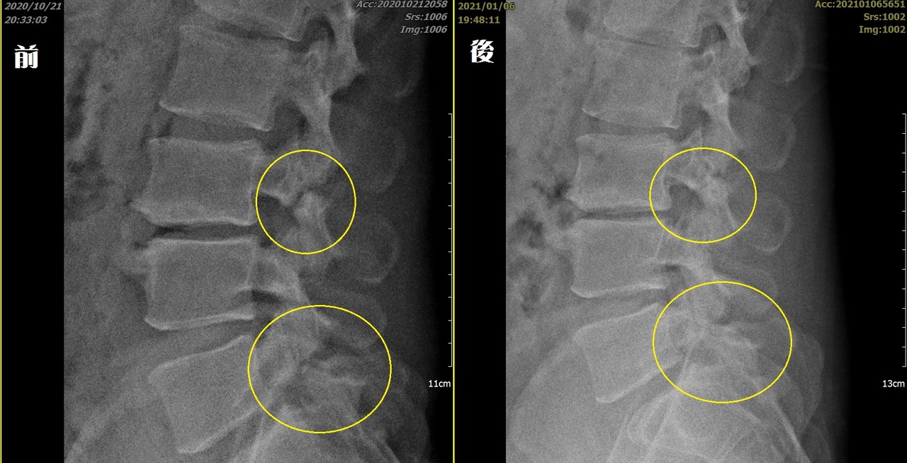 司機跌倒致椎弓兩處骨折進階水介質震波讓骨癒合 生活新聞 生活 聯合新聞網