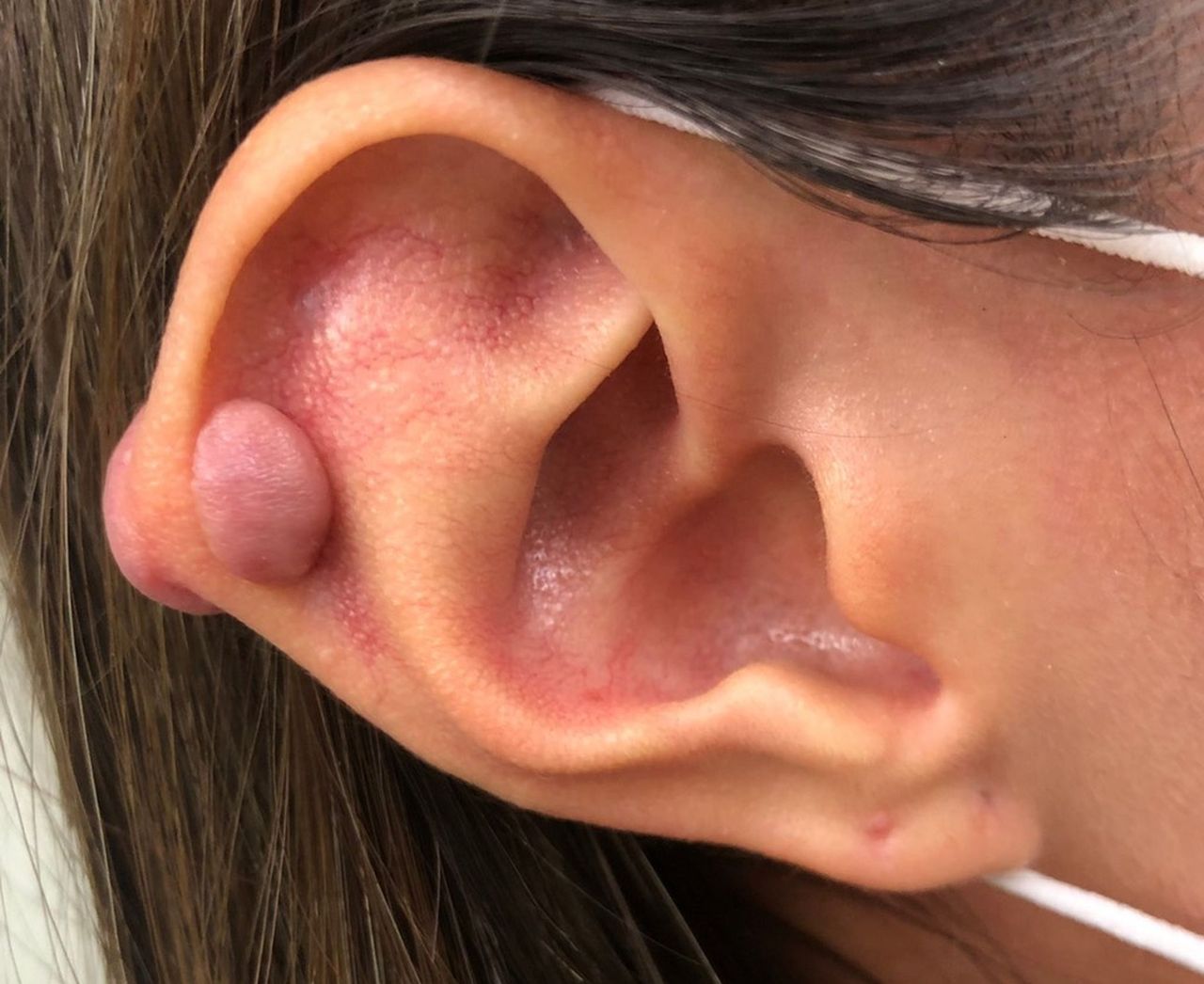 影 女大生打耳洞卻長出2顆小肉瘤原來是蟹足腫惹禍 生活新聞 生活 聯合新聞網