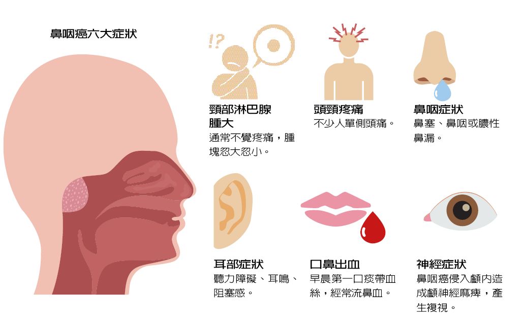 健保大數據看鼻咽癌5 4 基因病毒醃漬物3大危險因子 生活新聞 生活 聯合新聞網