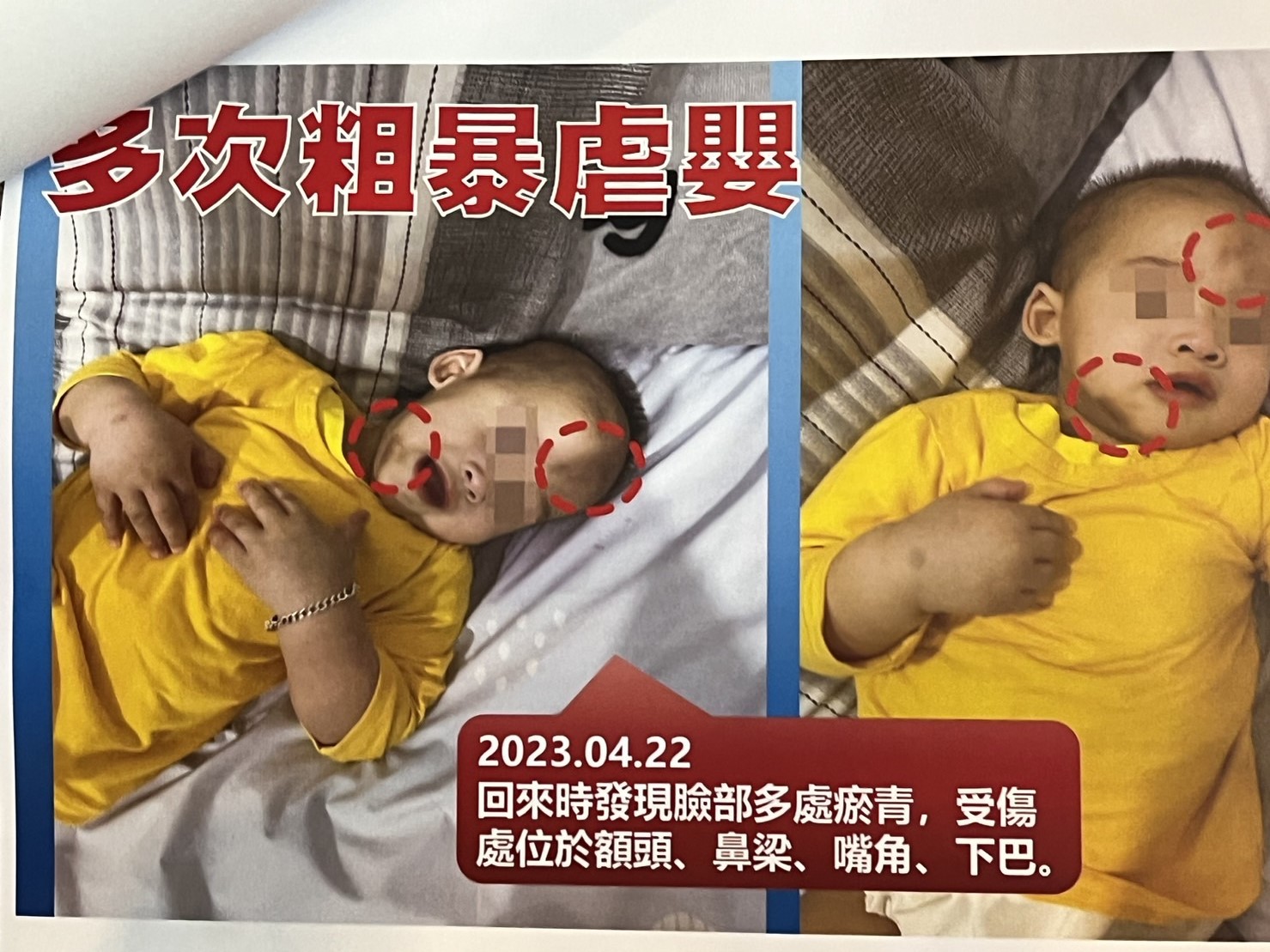 [新聞] 台南驚傳虐嬰未足1歲男嬰滿臉傷 疑被毆