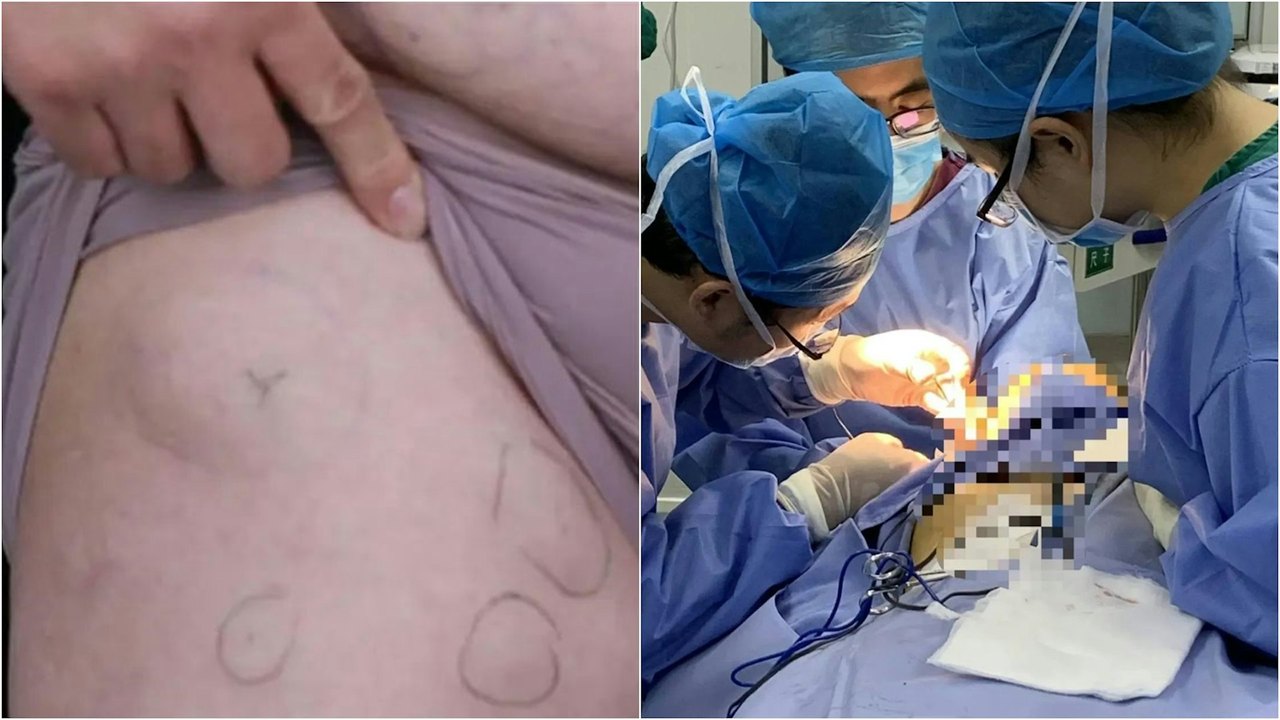 陈先生身上的「疙瘩 」，4名医生同台为陈先生做手术切除脂肪瘤。图／撷自《极目新闻》