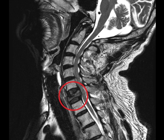 男子肩颈酸痛经核磁共振等检查，发现颈椎第七节转移性肿瘤。图／活力得中山脊椎外科医院提供