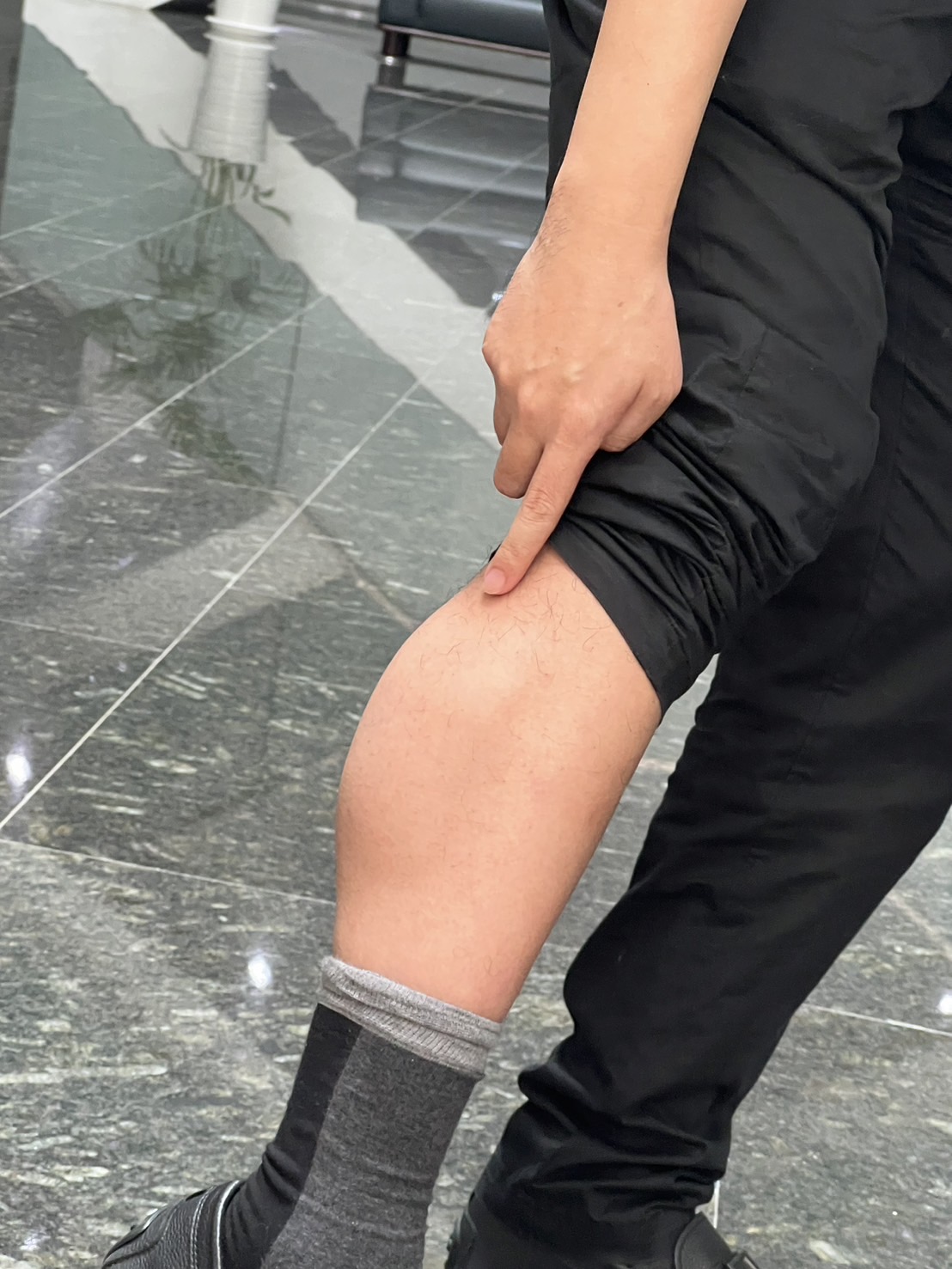 台中市研考会主委刘彦澧拉起裤管，出示右小腿有肿瘤，也是当年免服兵役的原因。记者陈秋云／摄影