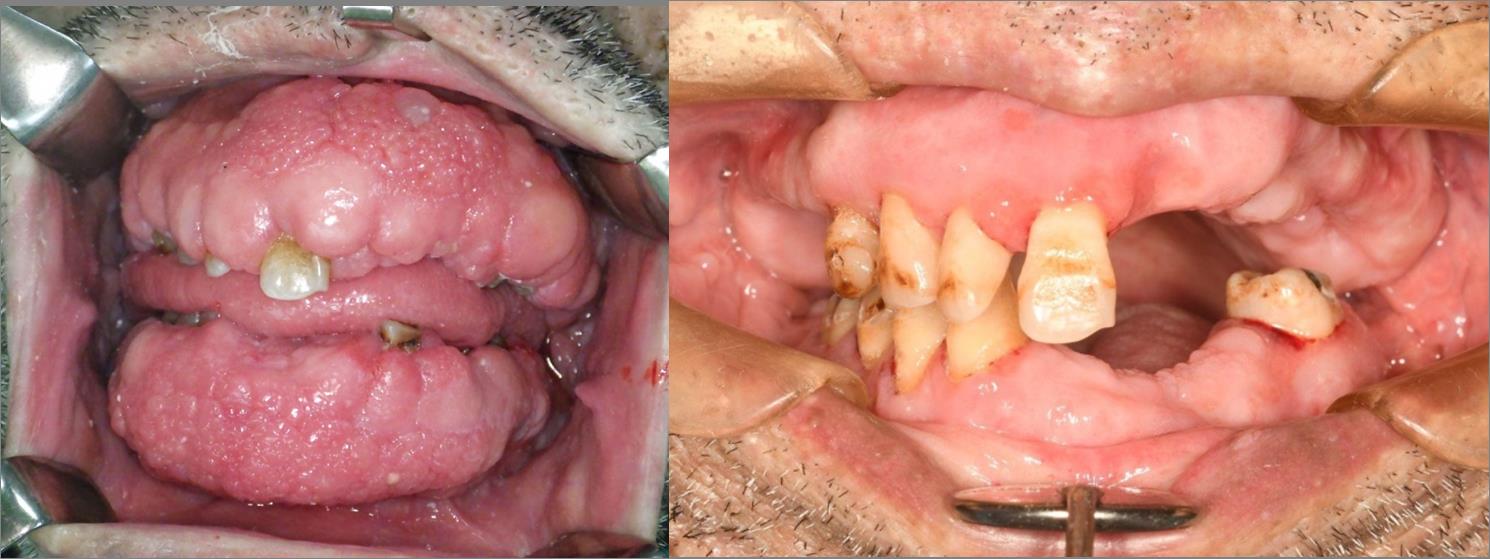 治疗前口腔牙龈纤维瘤多到看不见牙齿（图左），经过电烧合并二氧化碳雷射切除肿瘤手术后4周可以看见牙齿（图右）。图／高医提供