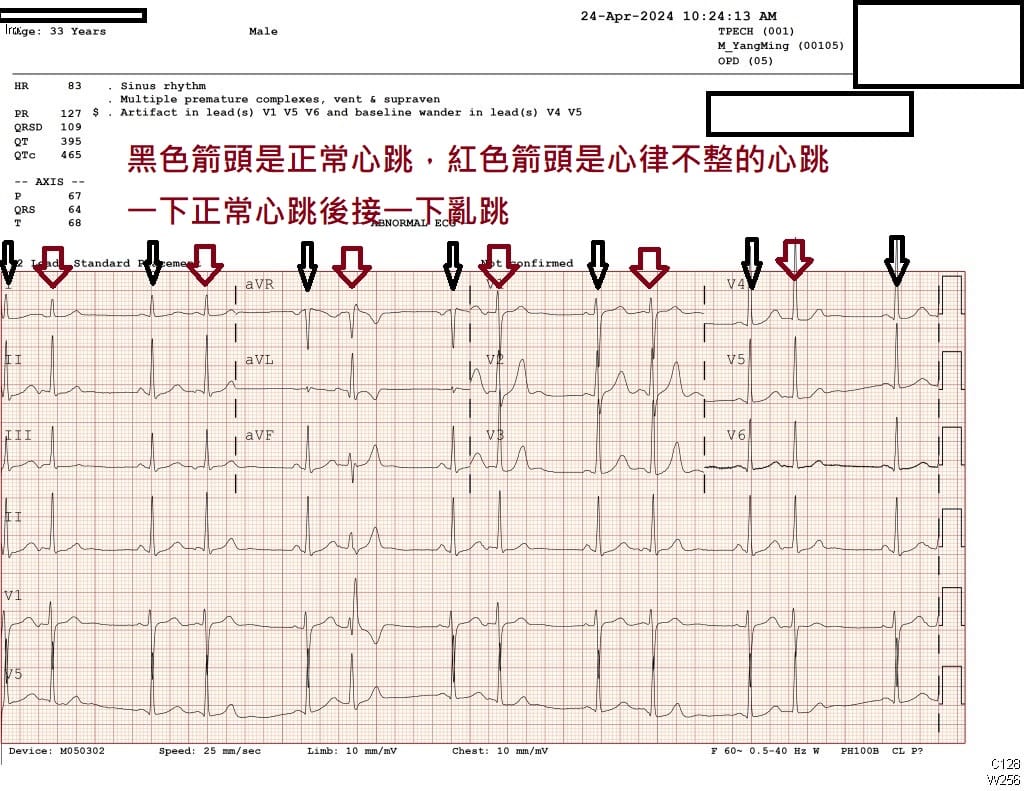 一名30岁的男性患者，在0403花莲大地震之后出现心律不整问题，一跳正常的心跳后面紧接一跳乱跳的心跳。图／取自苏一峰脸书