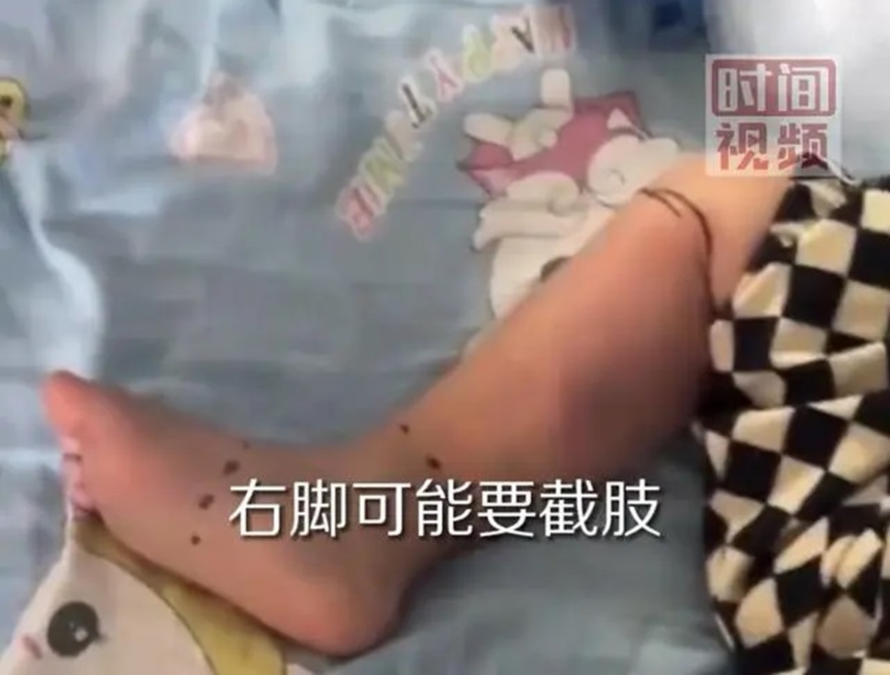 市场摸一下鱼感却染致命「弧菌」，珠海2岁男童右脚恐截肢。（取自微博影片截图）