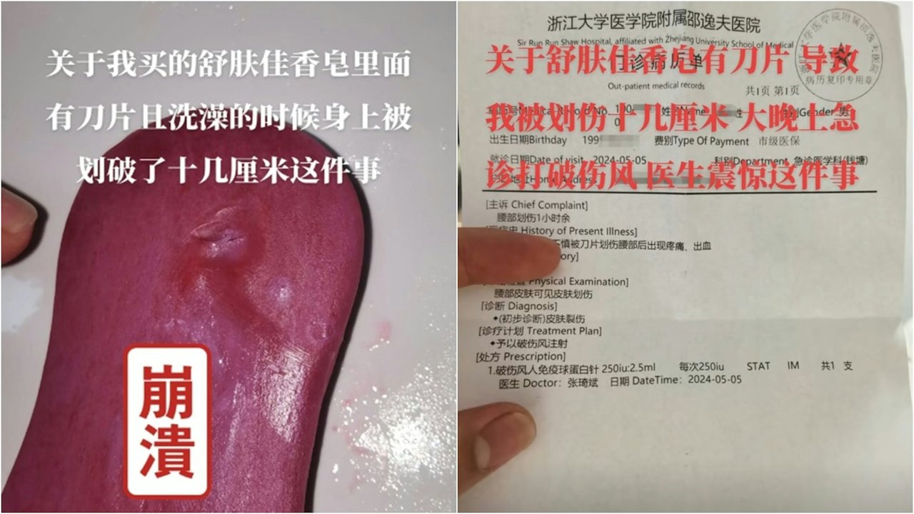 浙江杭州一名网友5日反映，洗澡时被舒肤佳肥皂内的刀片割伤腰部，伤口长达10公分。图／撷取自影音