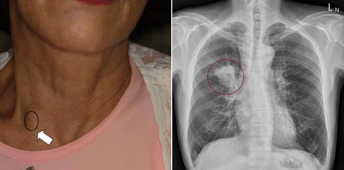 1名患者在锁骨上窝摸到硬的淋巴结，检查竟发现肺部长肿瘤。图／取自苏一峰脸书