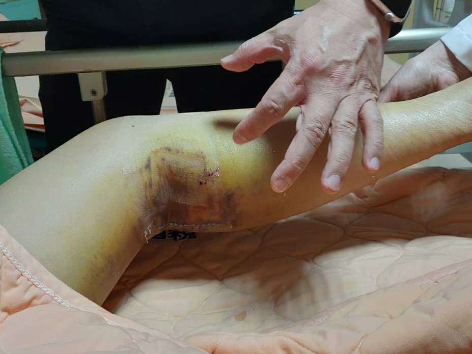 员荣医疗体系员荣医院心脏外科主任赖金湖，为蒙古少妇手术处理左下肢深部静脉栓塞，患者伤口只有个一个针头大小。图／员荣医疗体系提供