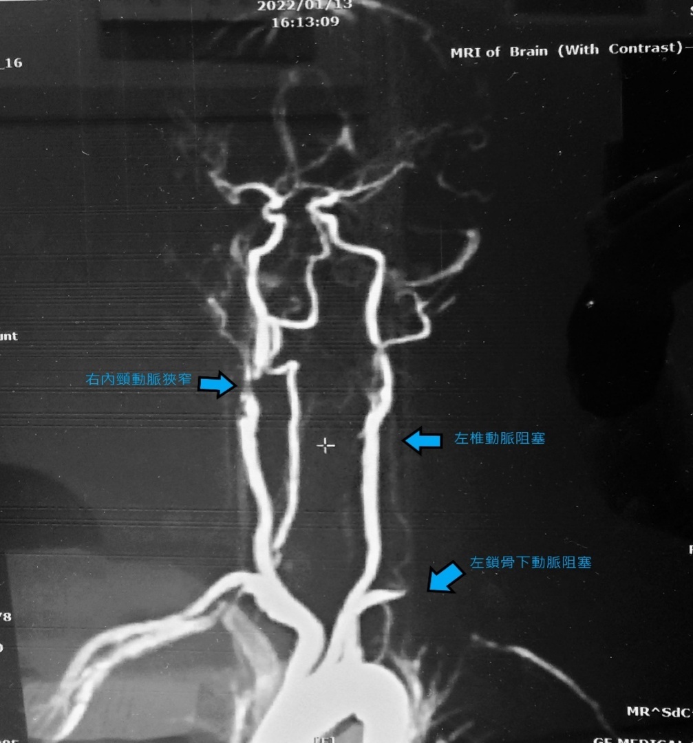 转头向左常昏倒竟是弓箭手症候群作祟 医药百科 健康 世界新闻网